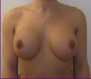 After large implants 650 cc